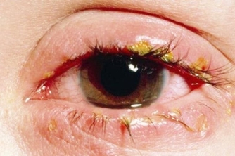 Nên hay không nên khi chữa bệnh đau mắt bằng mật ong